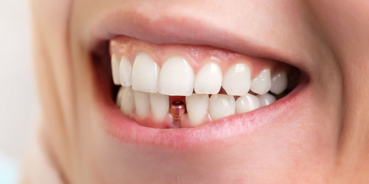 dental implant procedure