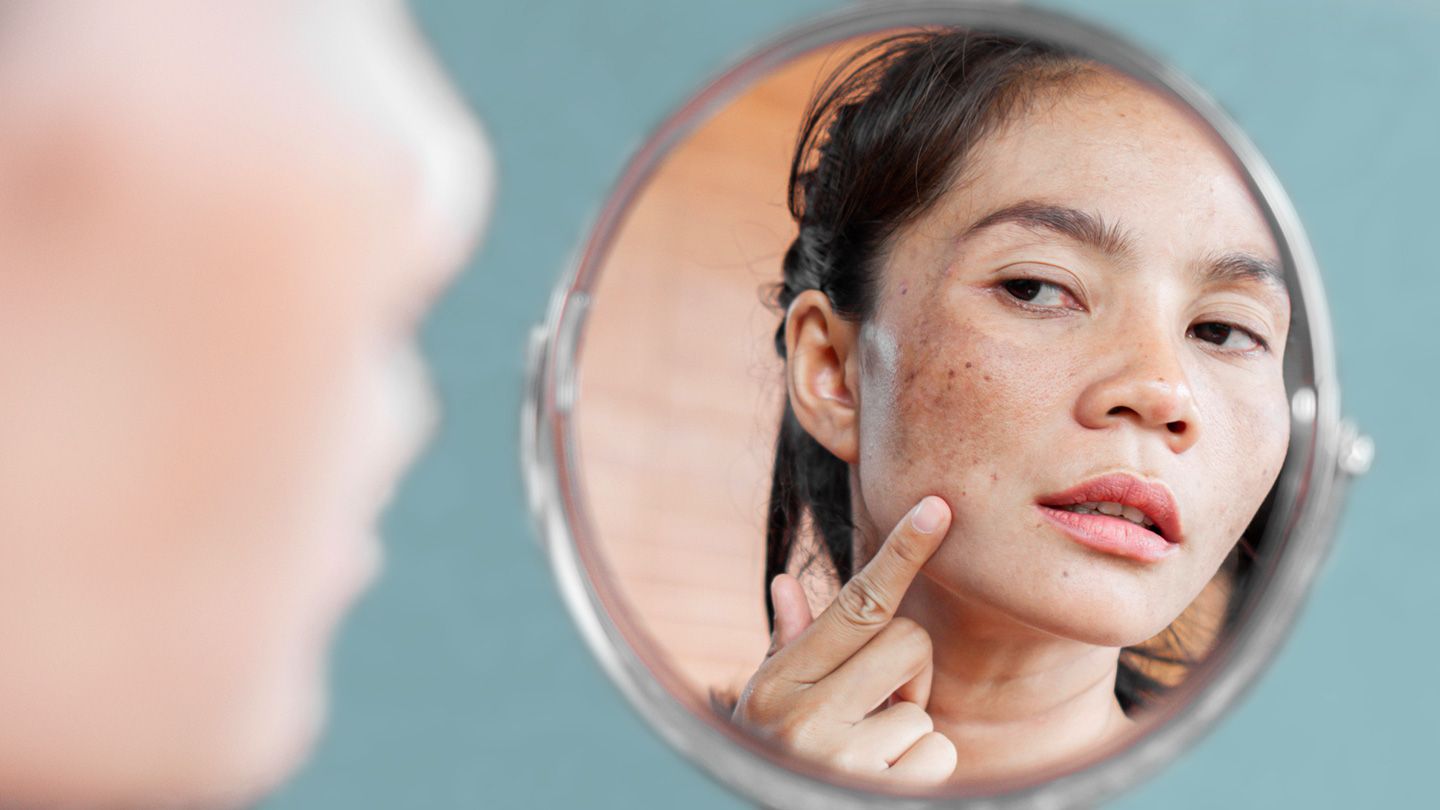 Excellent Reasons for Getting Skin Pigmentation Treatment