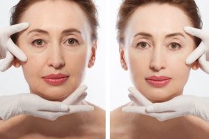 Everything that you should know about facelift